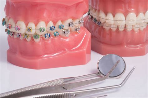 clarity advanced braces